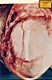 Wound in skull of Kimberley MacDonald